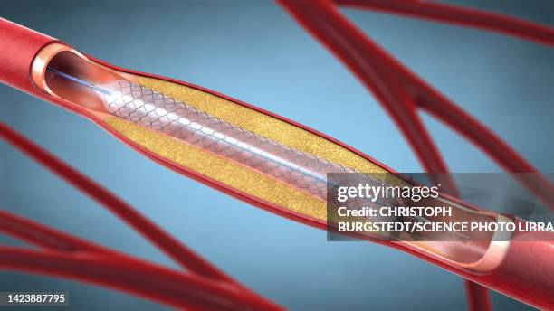 stockillustraties, clipart, cartoons en iconen met stent, illustration - stent