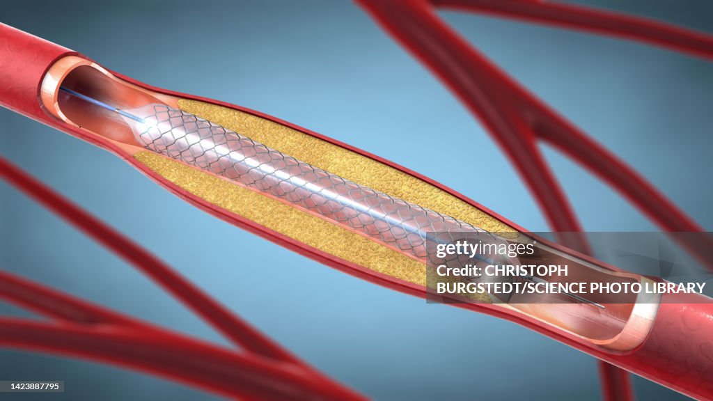 Stent, illustration
