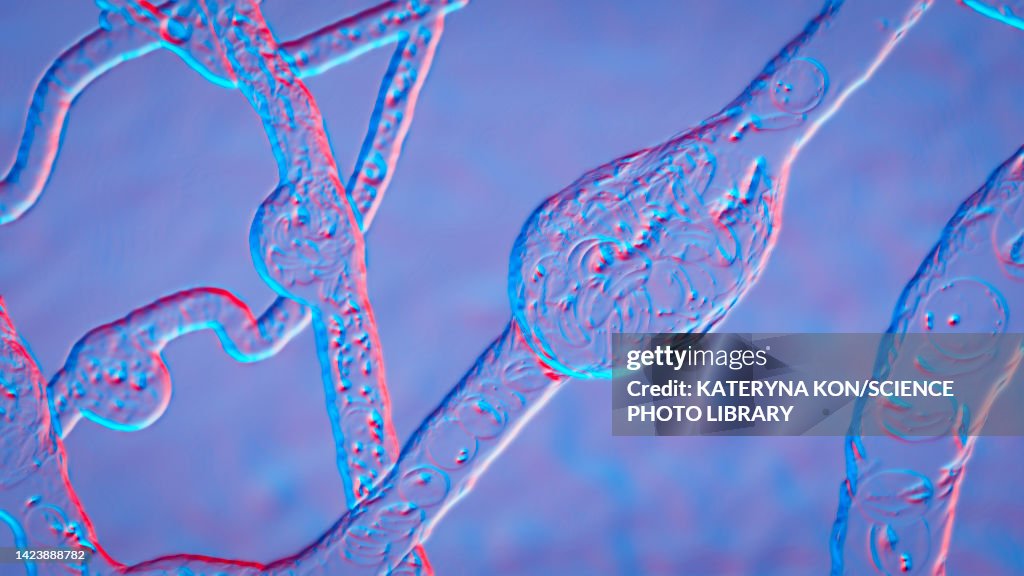 Microaneurysms, illustration