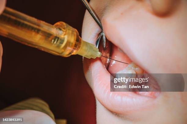 close up  dentist giving anaesthetic injection on young chinese boy patient tooth - wortelkanaal stockfoto's en -beelden