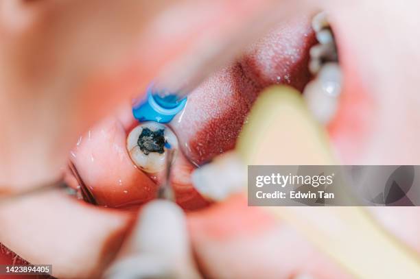 close up patient mouth open with suction tube dentist examining tooth filling - dental caries stockfoto's en -beelden