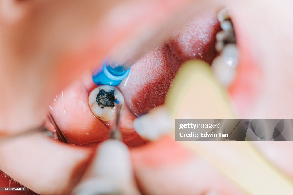 Close up patient mouth open with suction tube dentist examining tooth filling