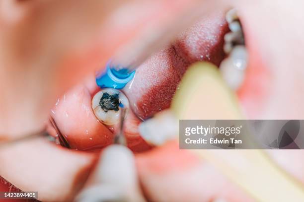 close up patient mouth open with suction tube dentist examining tooth filling - root canal procedure stock pictures, royalty-free photos & images