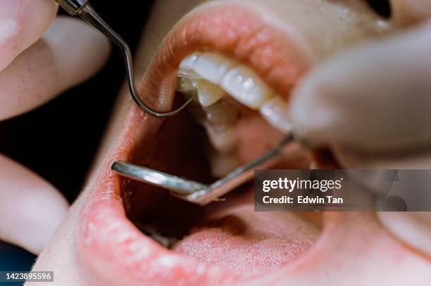nahaufnahme asiatische chinesische patientin offener mund für zahnarzt, der ihre zahnroutineuntersuchung untersucht - root canal procedure stock-fotos und bilder