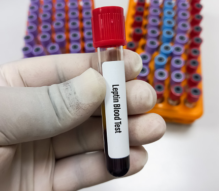 Blood sample for Leptin test. This test measures the amount of leptin in the blood to detect a deficiency that may be contributing to obesity.