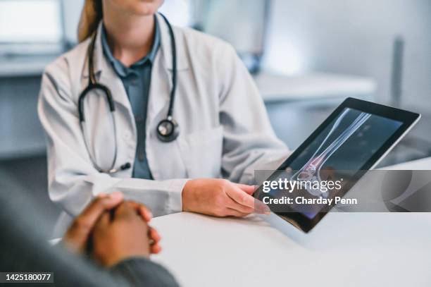 doctor consulting patient on ankle xray results to help give professional medical advice on leg, foot and joint accident. healthcare worker in x ray consultation in emergency hospital using a tablet - tornozelo imagens e fotografias de stock