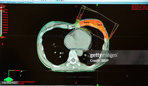 radiotherapy - radiotherapy stock pictures, royalty-free photos & images