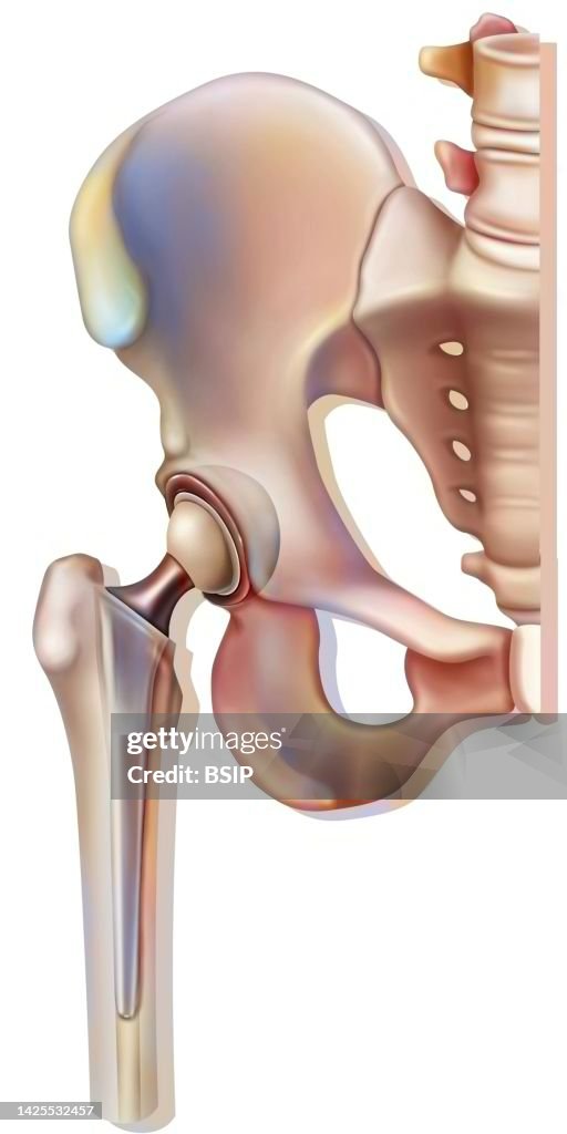 Hip prosthesis drawing