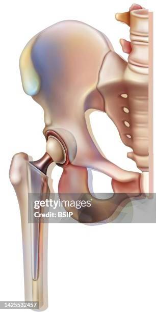 hip prosthesis drawing - orthopedic surgeon stock illustrations