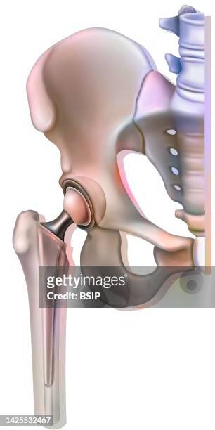 ilustrações, clipart, desenhos animados e ícones de hip prosthesis drawing - cirurgião ortopédico