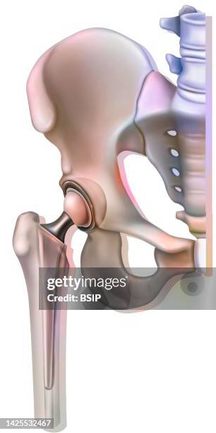 hip prosthesis drawing - orthopedic surgeon stock illustrations