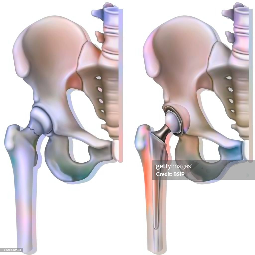 Hip prosthesis drawing