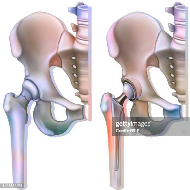 hip prosthesis drawing - orthopedic surgeon stock illustrations