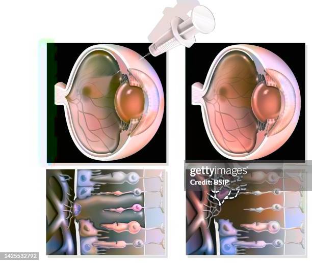dmla drawing processing - macular degeneration stock illustrations