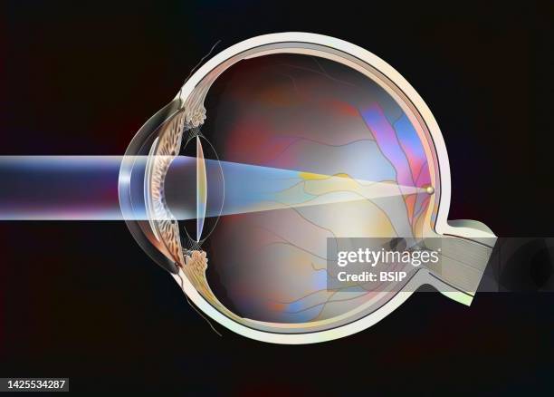 cataract implant - anterior chamber stock illustrations