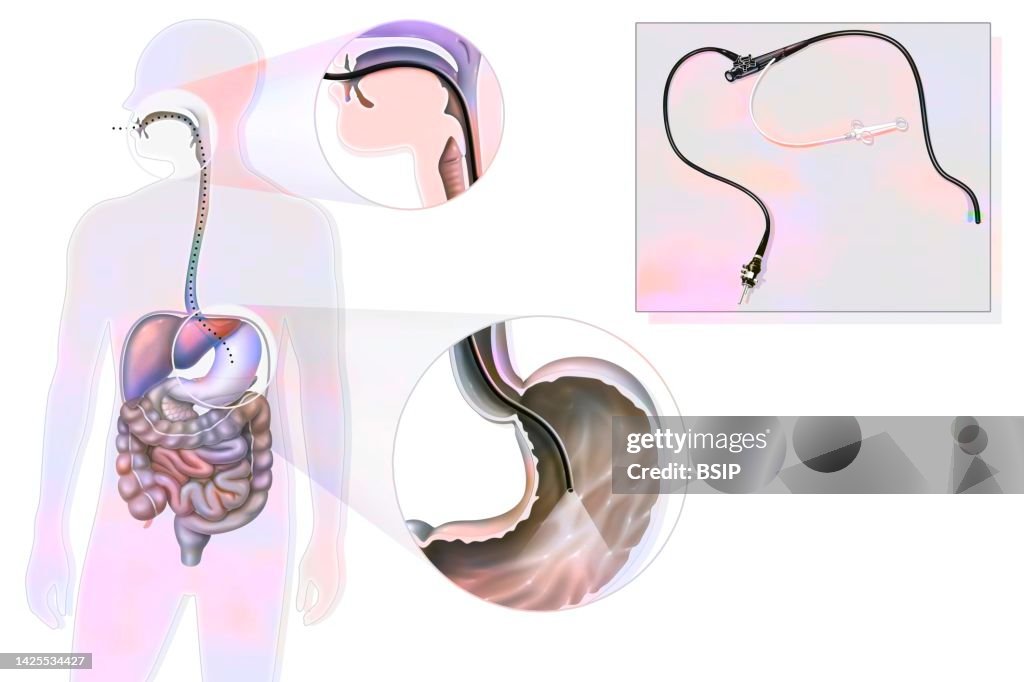 Python Endoscopy Stomach Endoscopy Drawing High-Res Vector Graphic - Getty Images