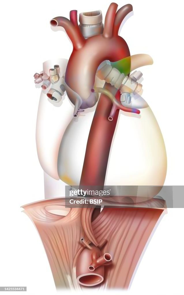 Aorta drawing