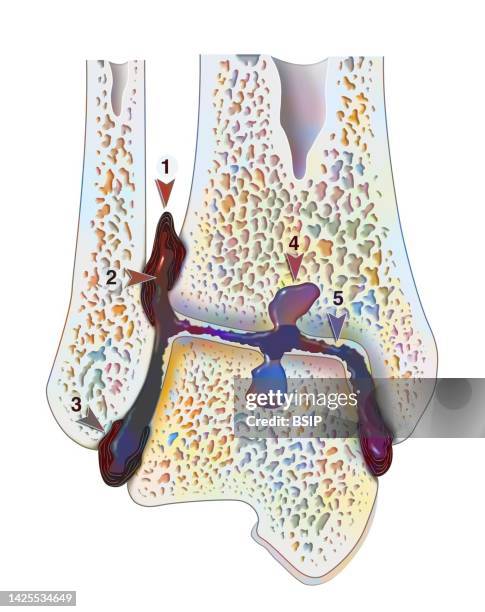 hemophilic arthropathy - ankle stock illustrations
