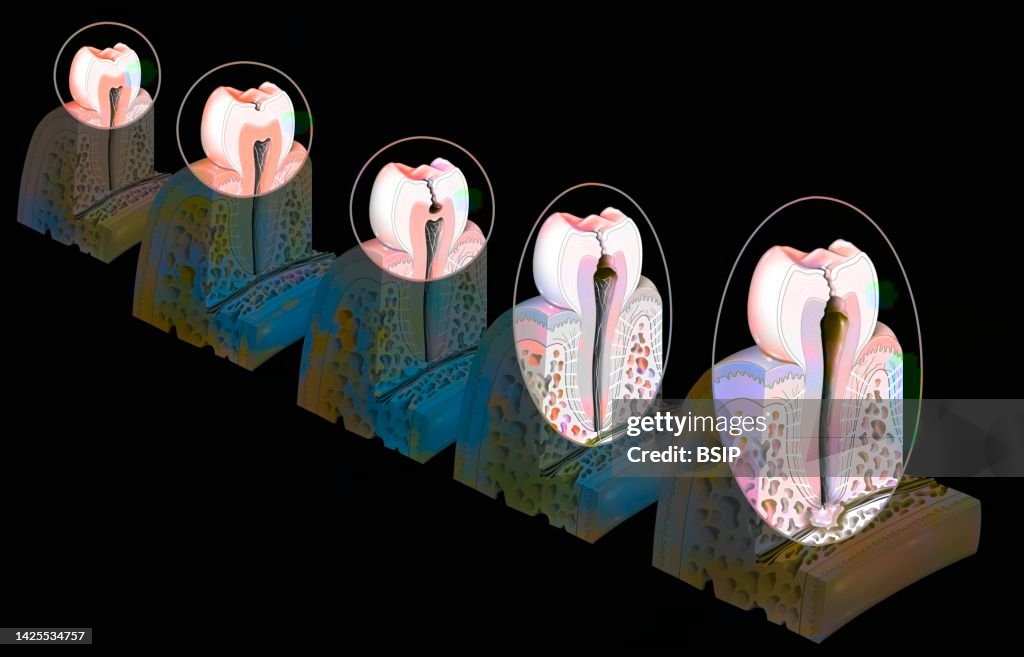 Tooth decay drawing