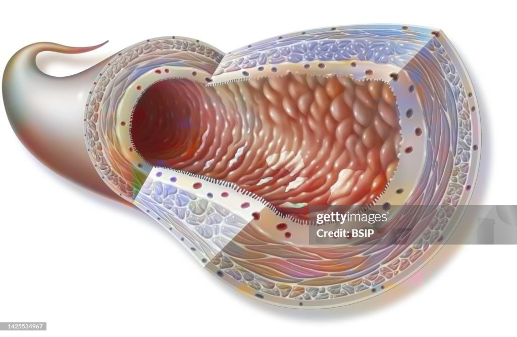 Crohn's disease drawing