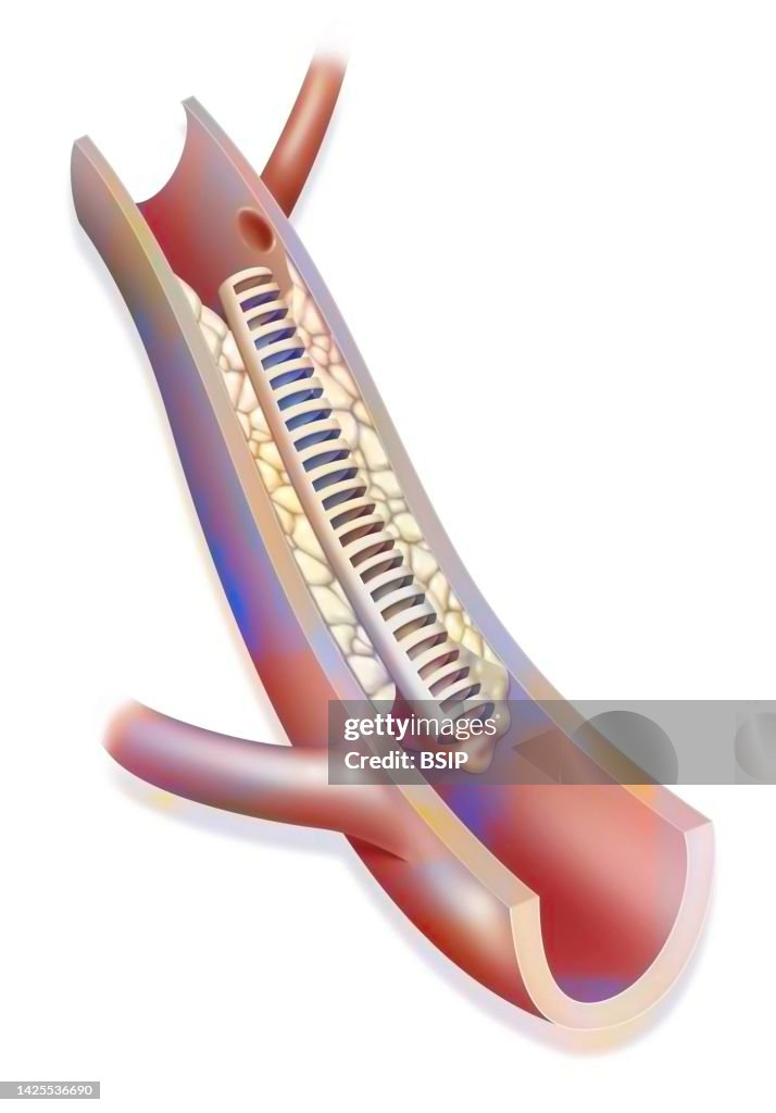 Angioplasty artery drawing