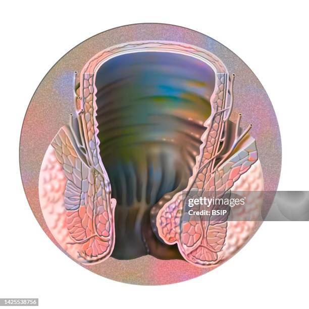 hemorrhoid drawing - hemorrhoid 幅插畫檔、美工圖案、卡通及圖標