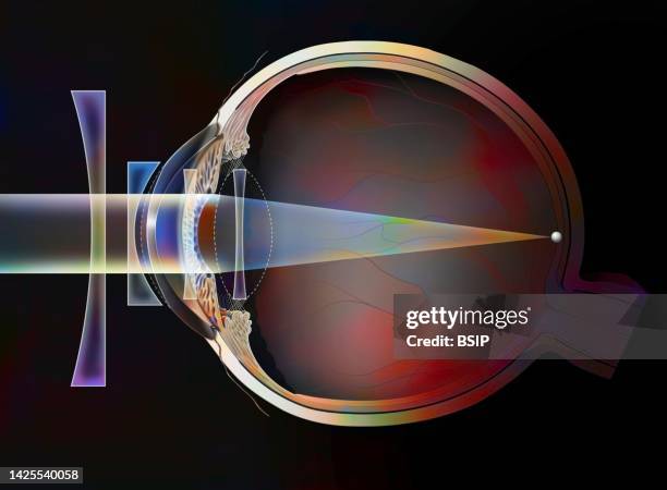 myopia treatment drawing - anterior chamber stock illustrations