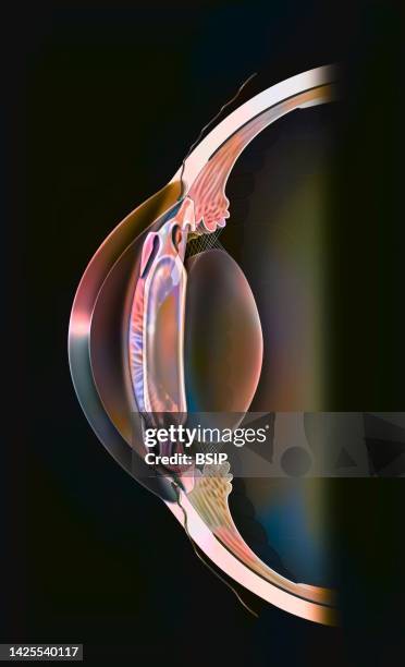 eye implant - posterior chamber stock illustrations