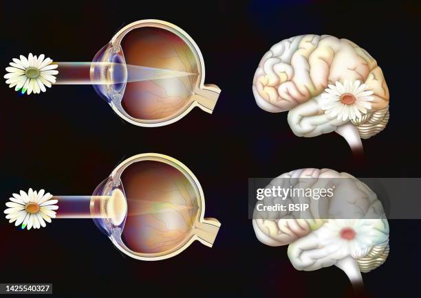 ilustrações de stock, clip art, desenhos animados e ícones de cataract drawing - córtex visual