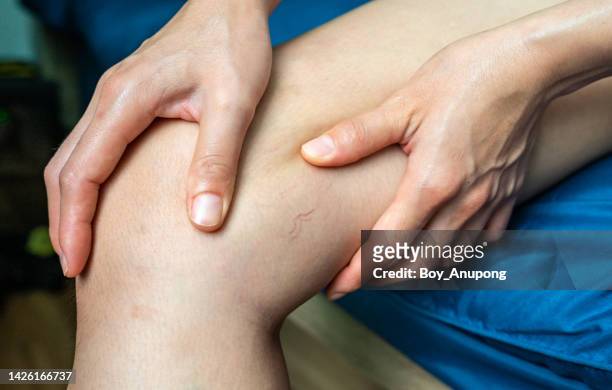 close up of spider veins occur on woman thigh. - bloedcirculatie stockfoto's en -beelden