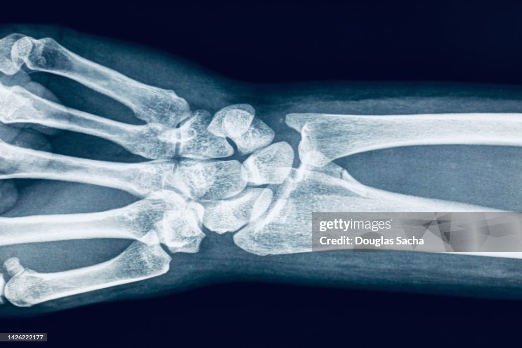 X-ray image of the human wrist