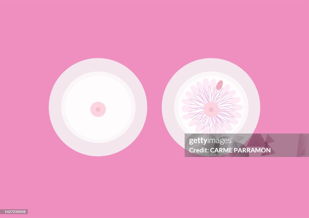 Breast Brustkrebs