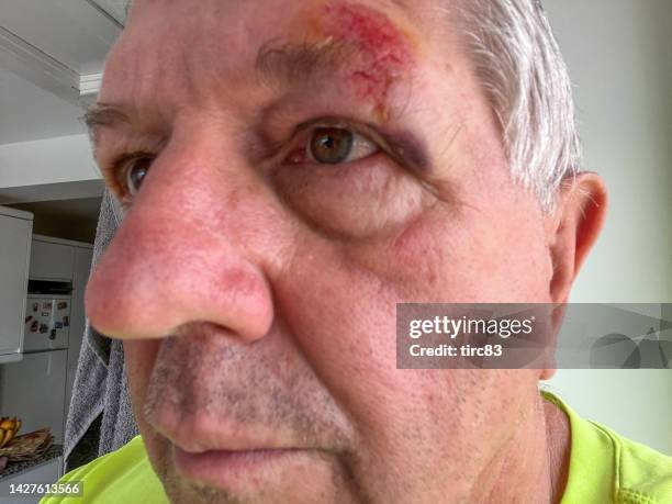 hombre mayor con lesión en el ojo negro - bruise fotografías e imágenes de stock