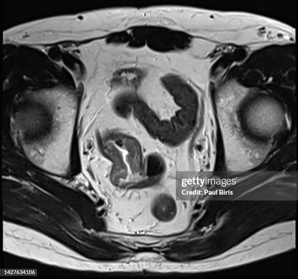 sigmoid colon cancer seen on axial t2 image on mri (magnetic resonance imaging) - anus foto e immagini stock
