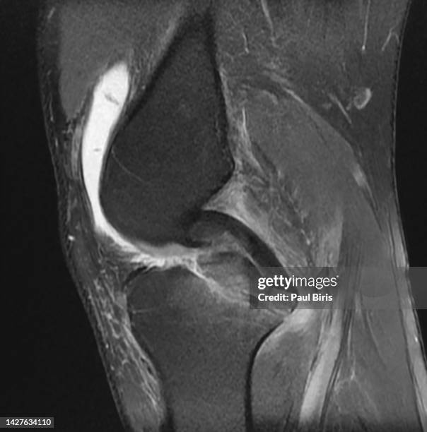 tibial plateau fracture with avulsion fracture of tibial tuberosity, sagittal pd fatsat image - comminuted fracture stock pictures, royalty-free photos & images