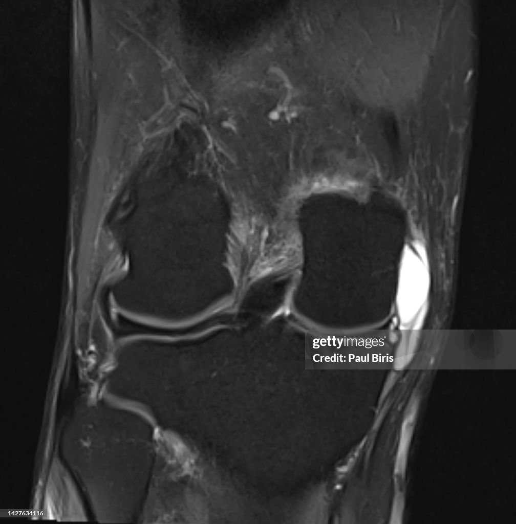 A giant medial parameniscal cyst of the knee joint, Magnetic resonance imaging MRI knee posterior horn medial meniscus tear, coronal FatSat View
