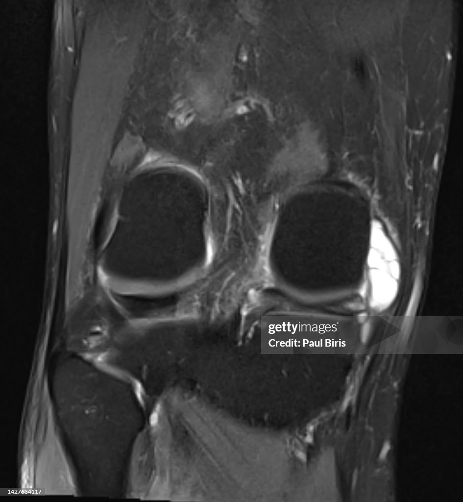 A giant medial parameniscal cyst of the knee joint, Magnetic resonance imaging MRI knee posterior horn medial meniscus tear, coronal FatSat View