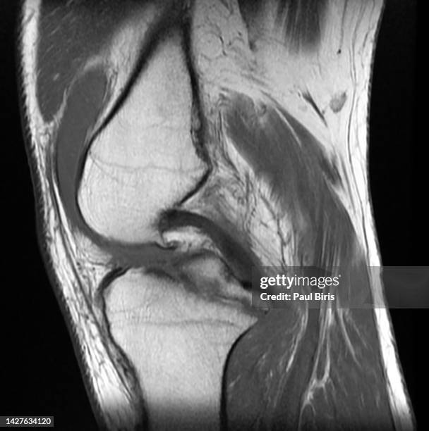 tibial plateau fracture with avulsion fracture of tibial tuberosity, sagittal t1 image - comminuted fracture stock pictures, royalty-free photos & images