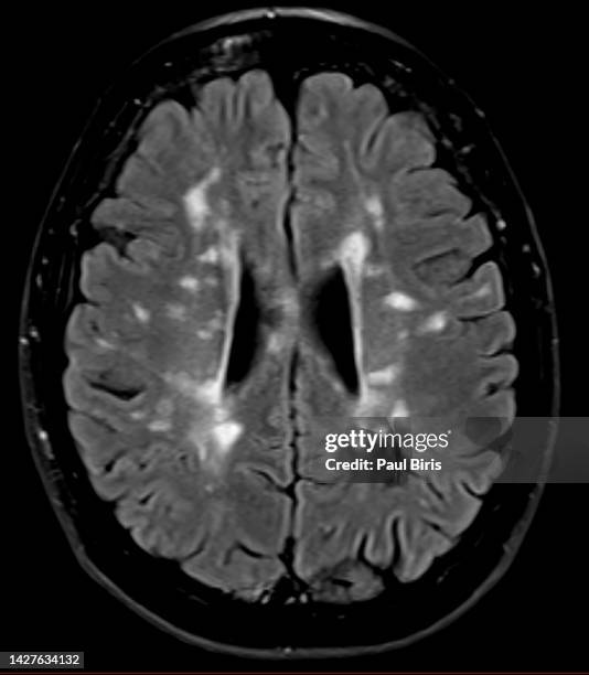 flair imaging for  multiple sclerosis (ms) on mri images - multiple sclerosis fotografías e imágenes de stock