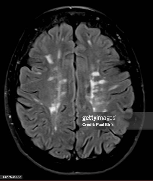 flair imaging for multiple sclerosis (ms) on mri images - multiple sclerosis stock pictures, royalty-free photos & images
