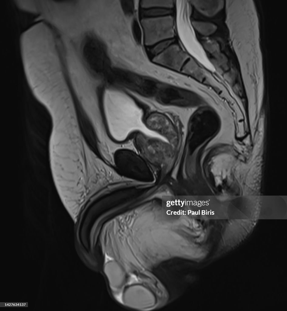Transurethral resection of the prostate (TURP) seen on sagittal view on MRi T2 image