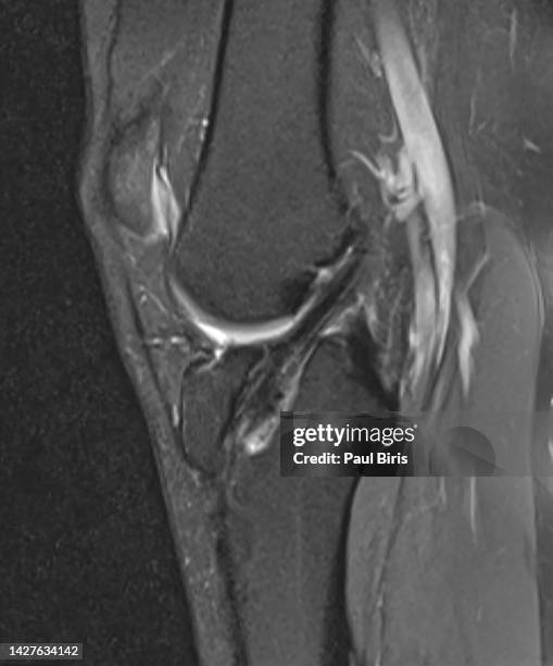 magnetic resonance imaging after anterior cruciate ligament reconstruction, sagittal view - rip science stock pictures, royalty-free photos & images