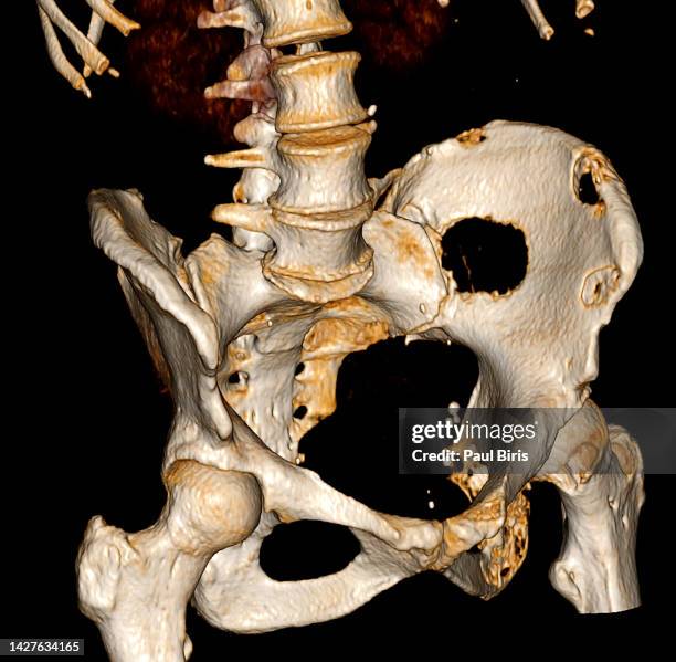 3d rendered ct of hip bone metastases - tumore metastatico foto e immagini stock