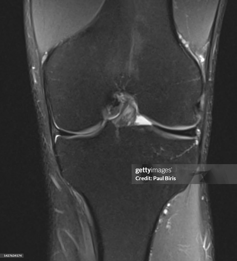Discoid lateral meniscus seen on coronal PD FatSat MRI image