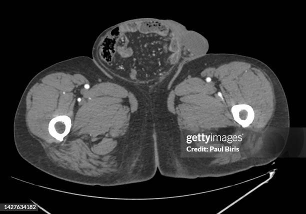 inguinal hernias seen on computer tomography axial view - hernia inguinal ストックフォトと画像