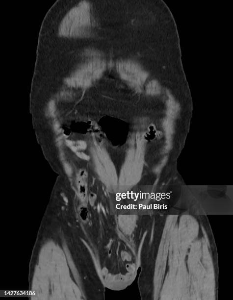 inguinal hernias seen on computer tomography coronal view - hernia inguinal ストックフォトと画像