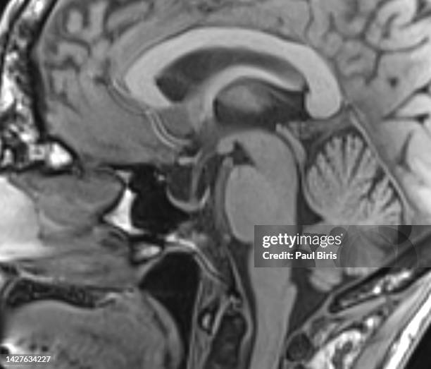 empty sella syndrome seen on sagittal mri (magnetic resonance imaging) t1 image - brain stem imagens e fotografias de stock