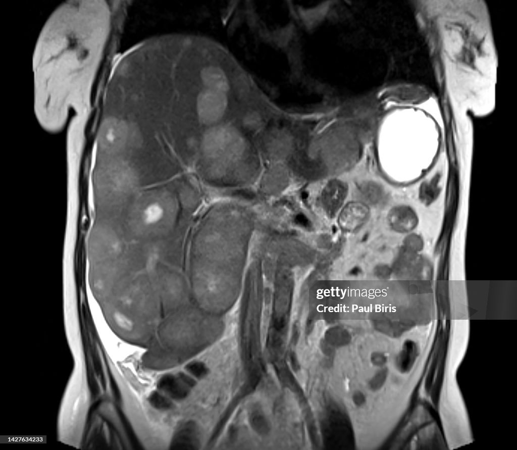 Magnetic Resonance Imaging of Liver Metastasis