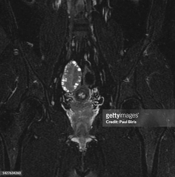 polycystic ovaries (pco) seen on coronal mri (magnetic resonance imaging) - ovarian cyst fotografías e imágenes de stock