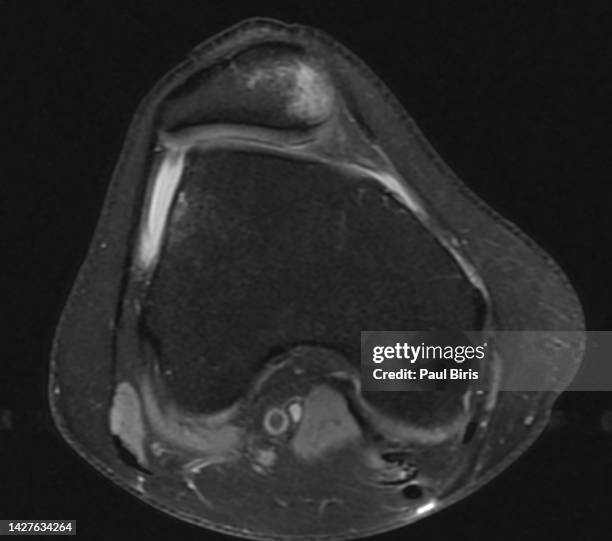 lateral patellar dislocation, axial pd fat sat image, seen on mri - meniscus stock pictures, royalty-free photos & images